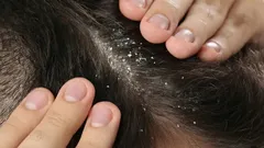 Não precisa de champô: diga adeus à caspa com a especiaria que existe em todas as casas